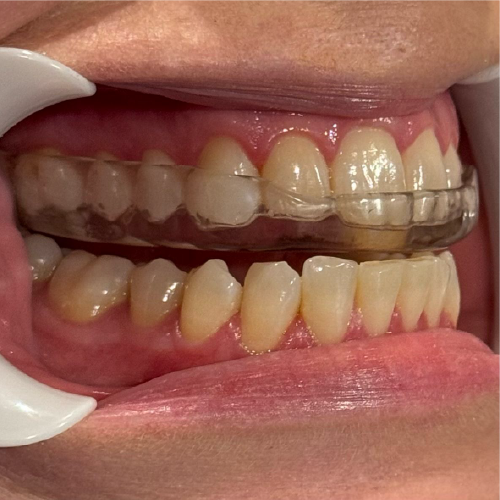 Armadillo soft/hard nightguard