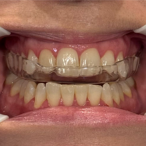 Armadillo soft/hard nightguard