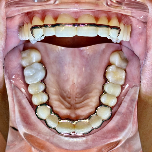 Atlas Maxillary Retainer
