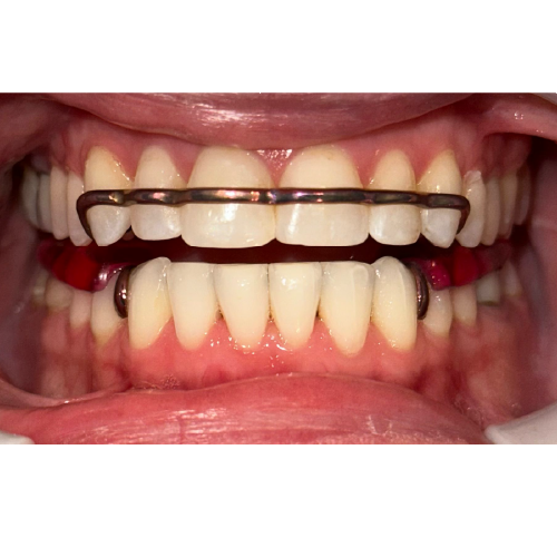 Atlas Maxillary and Atlas Mandibular TMD