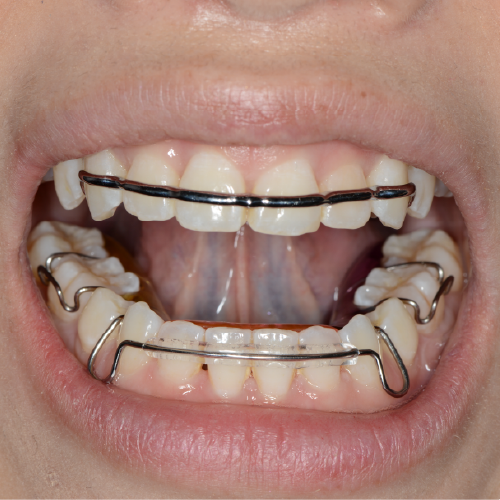 Hawley and Atlas Retainers