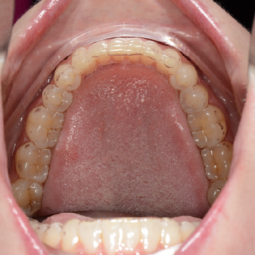 Hercules Clear Retainer