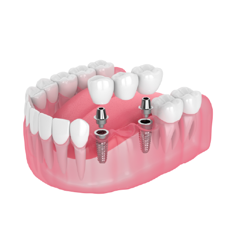 Implant Bridge