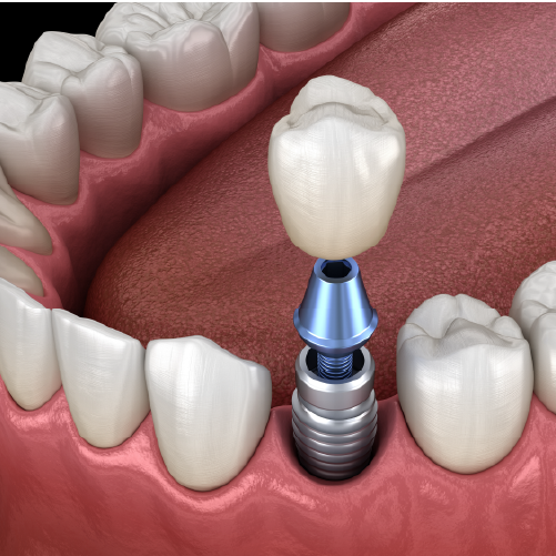 Implant Crown