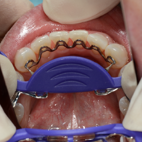 Infinity Serpentine with seating jig