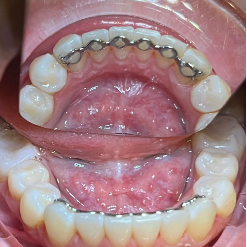 Infinity Fixed Lingual Retainer TMO (Lower)