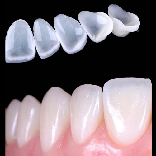 e.Max Veneers