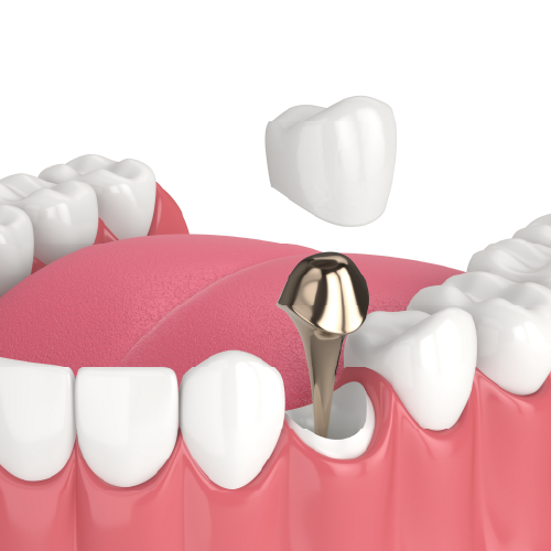 Implant Crown